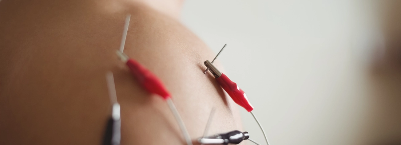 Imagen top acupuntura 1